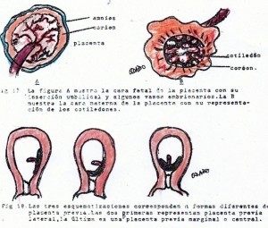 Placenta y Mola Hidatiforme 3 PDF
